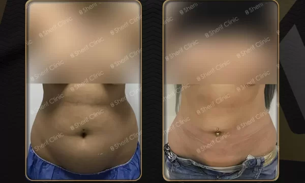 شفط ونحت دهون الجسم بالفيزر