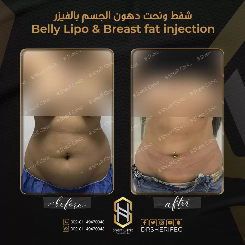 شفط ونحت دهون الجسم بالفيزر