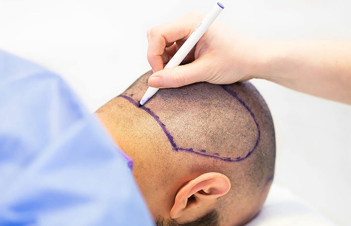 طريقة زراعة الشعر