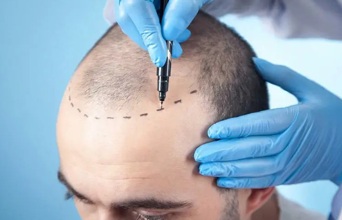 عمليات زراعة الشعر