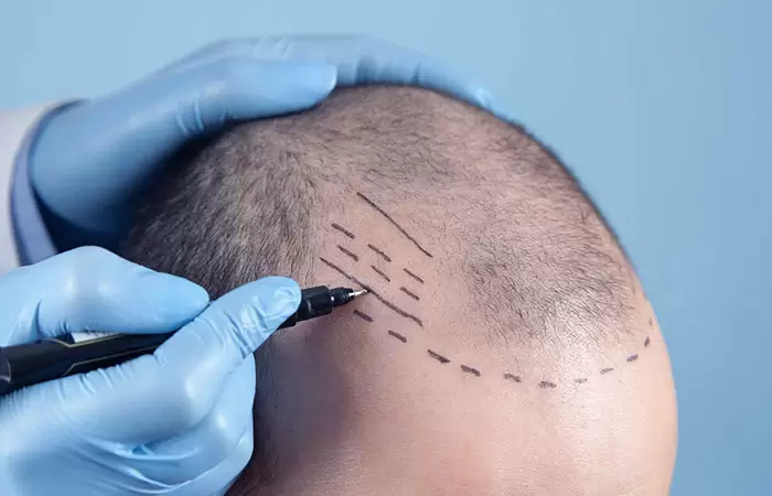 عملية زراعة الشعر