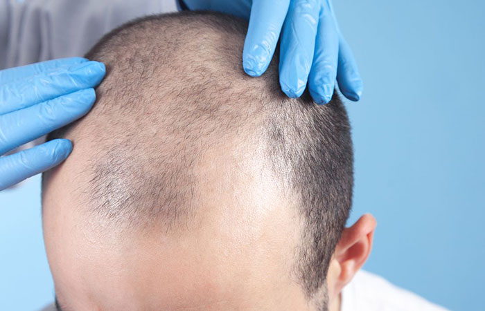 عملية زرع الشعر