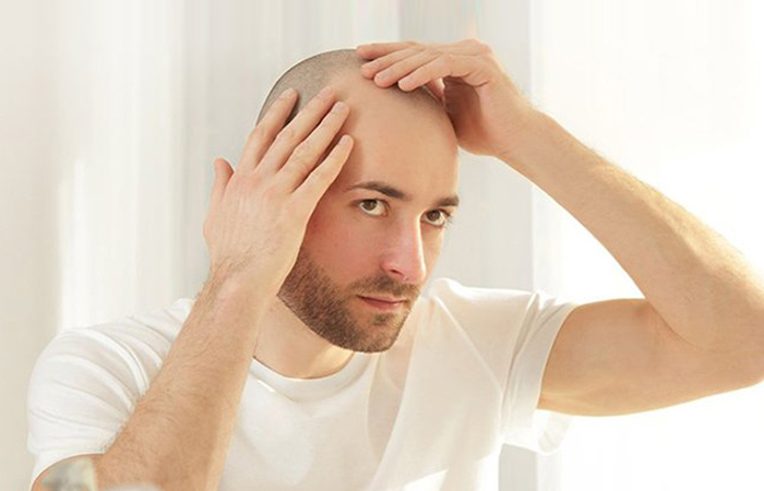 عيوب زراعة الشعر