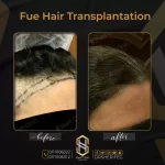 قبل وبعد زراعة الشعر للسيدات