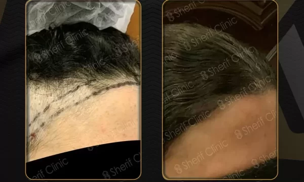 قبل وبعد زراعة الشعر للسيدات