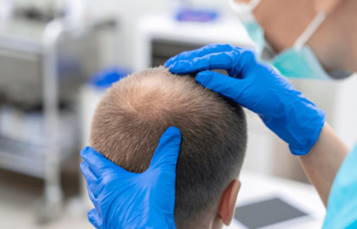 كيفية زراعة الشعر