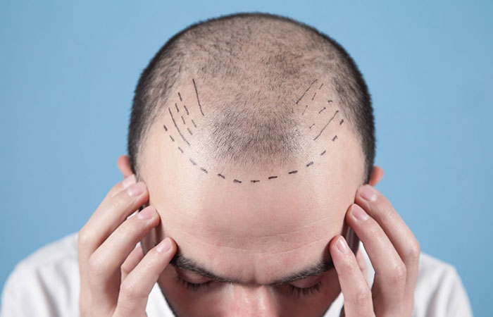 مخاطر زراعة الشعر