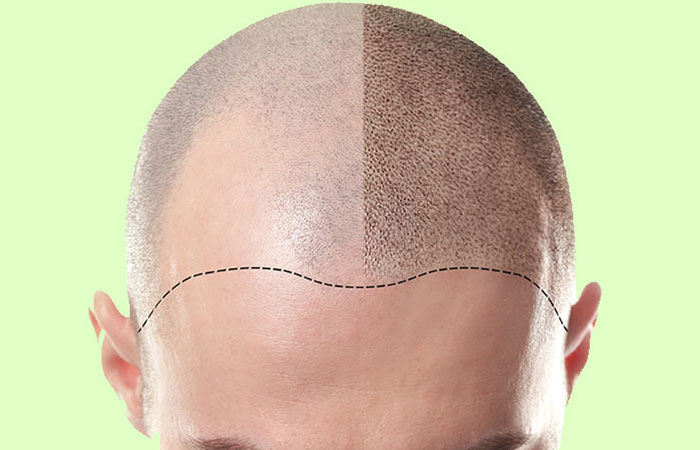 مراحل زراعة الشعر