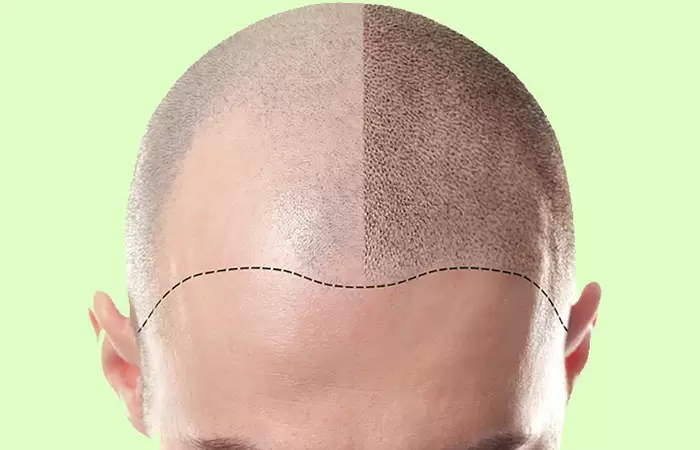 مراحل زراعة الشعر