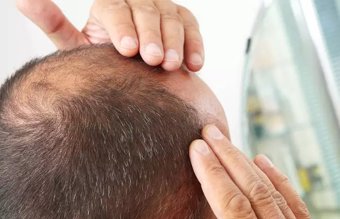 مركز زراعة الشعر