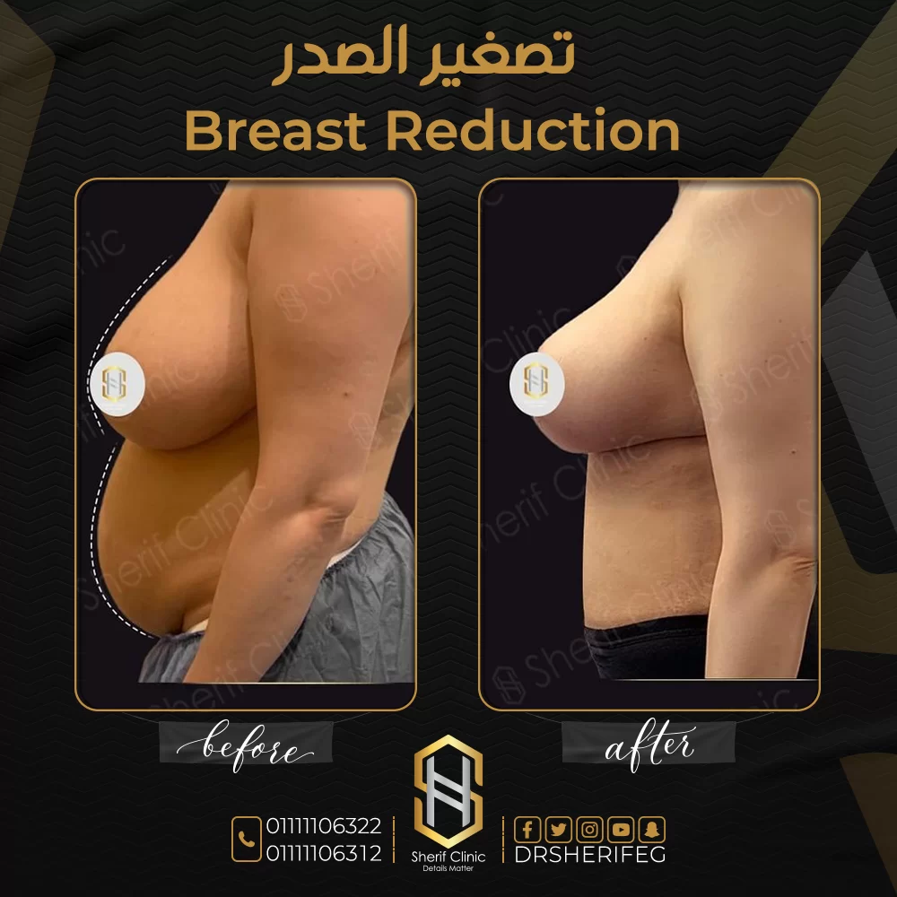 نتائج تصغير الثدي