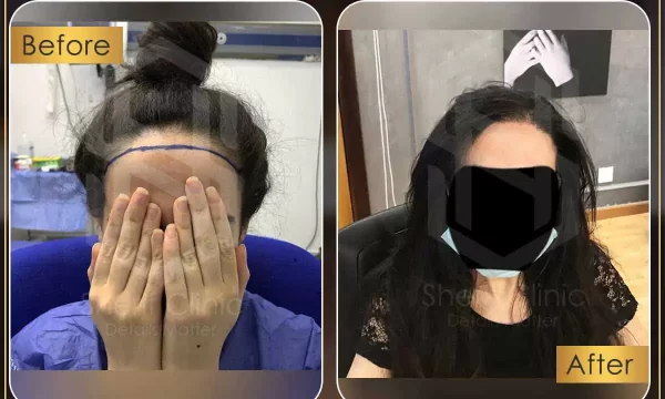 نتائج زراعة الشعر للسيدات