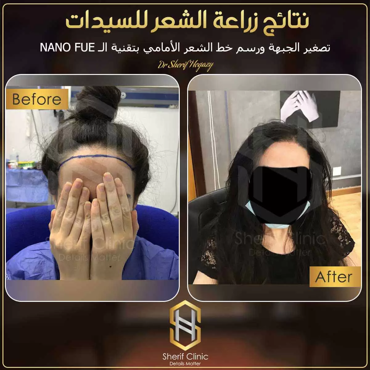 نتائج زراعة الشعر للسيدات