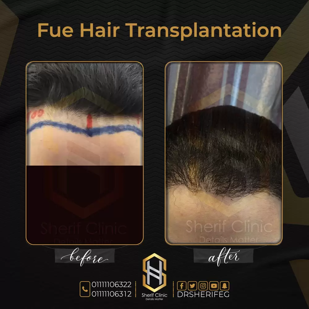 نتائج زراعة الشعر للنساء قبل وبعد