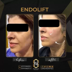 اندولفت endolift