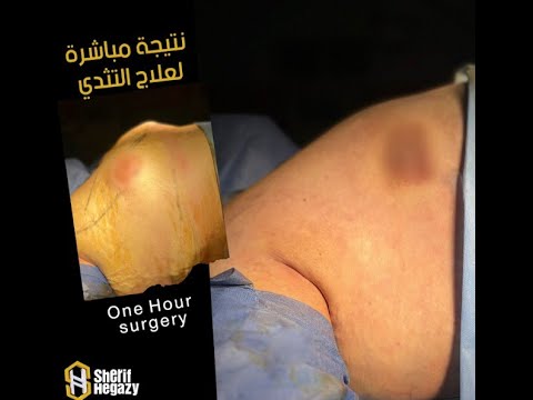 شاهد نتيجة علاج بروز الصدر عند الرجال (التثدي ) ونصائح من داخل غرفة العمليات