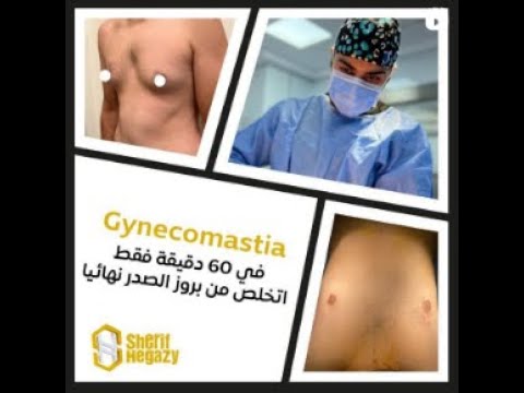 تخلص من بروز الصدر نهائياٌ في 60 دقيقة فقط
