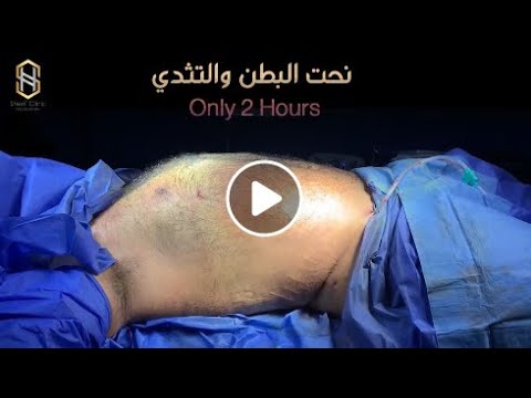 نحت البطن والتثدي في ساعتين فقط