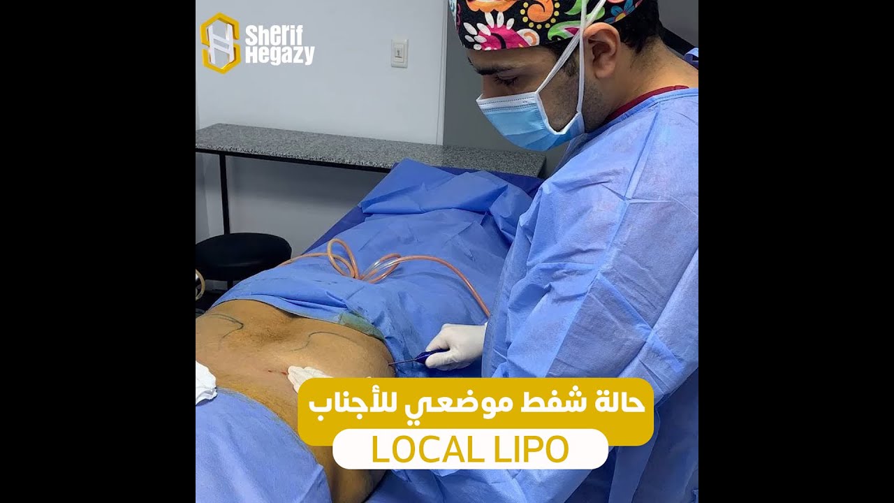 شفط موضعي للأجناب -30 دقيقة فقط