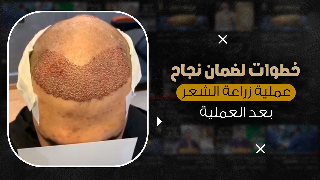 إليك بعض خطوات لضمان نجاح عملية زراعة الشعر بعد العملية
