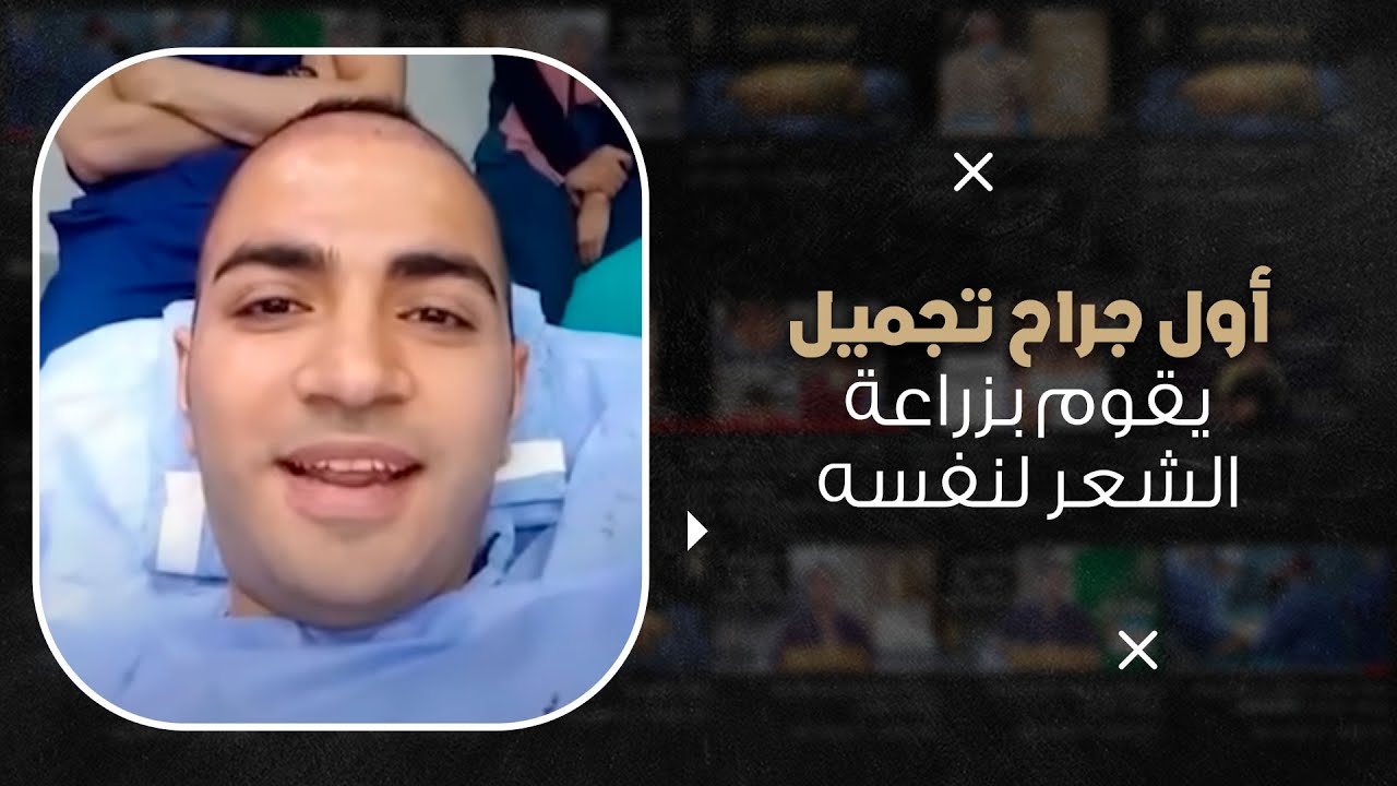 أول دكتور زراعة شعر يزرع لنفسه شاهد الفيديو من داخل العمليات
