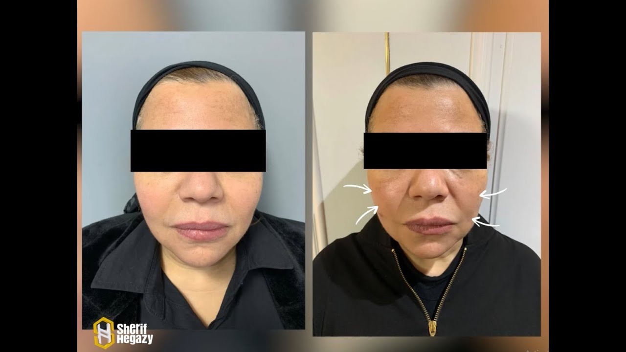 نهاية تجاعيد الوجه من أول جلسة - بدون جراحة