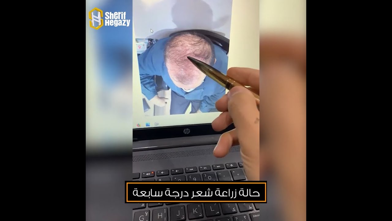 نتيجة غير متوقعة لزراعة الصلع من الدرجة السابعة
