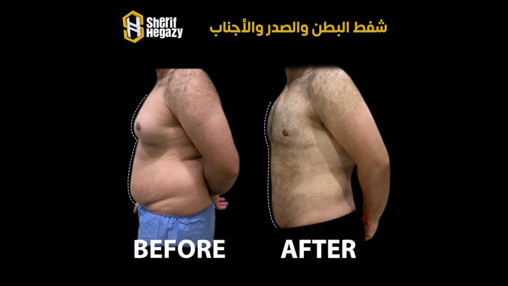 نتيجة مميزة لشفط الدهون بالفيزر