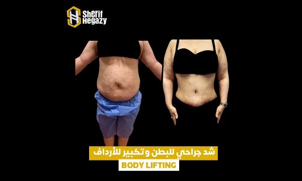 نتيجة اصلاح الولادات المتكررة عن طريق الشد الجراحي للبطن