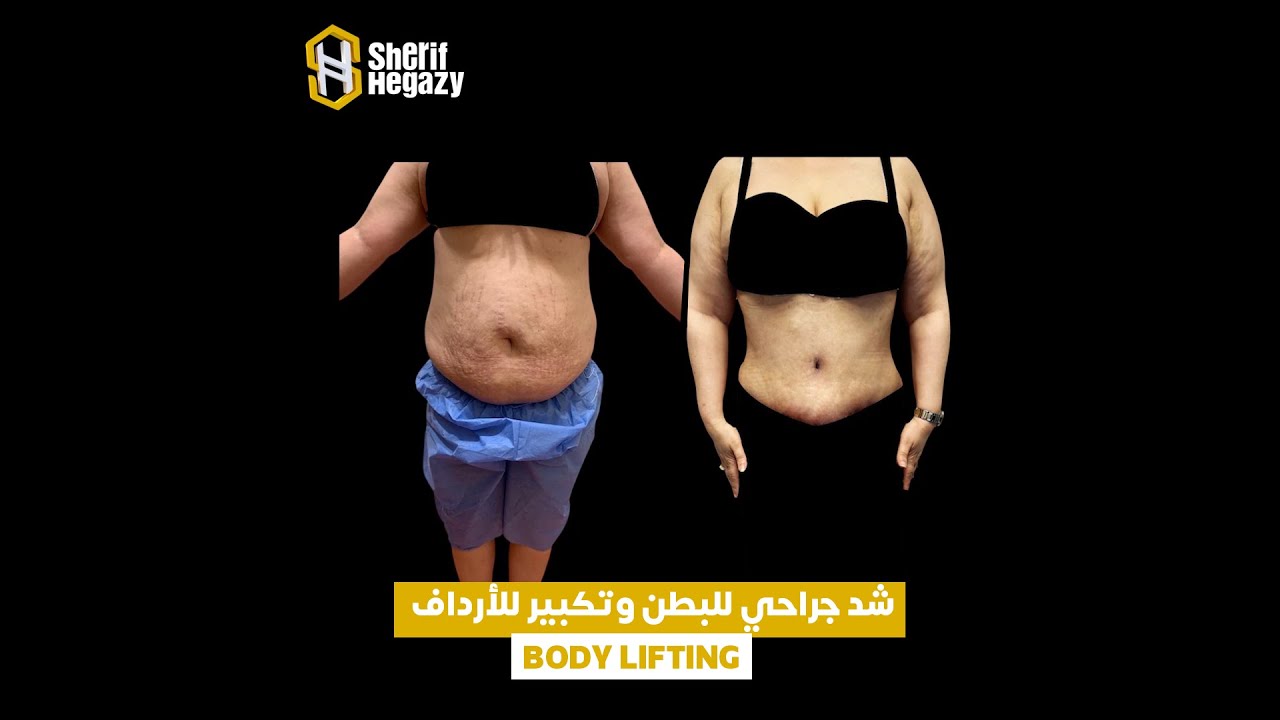 نتيجة اصلاح الولادات المتكررة عن طريق الشد الجراحي للبطن