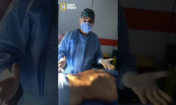 شاهد نتيجة التخلص من دهون البطن والاجناب الموضعي بنحت عالي التحديد
