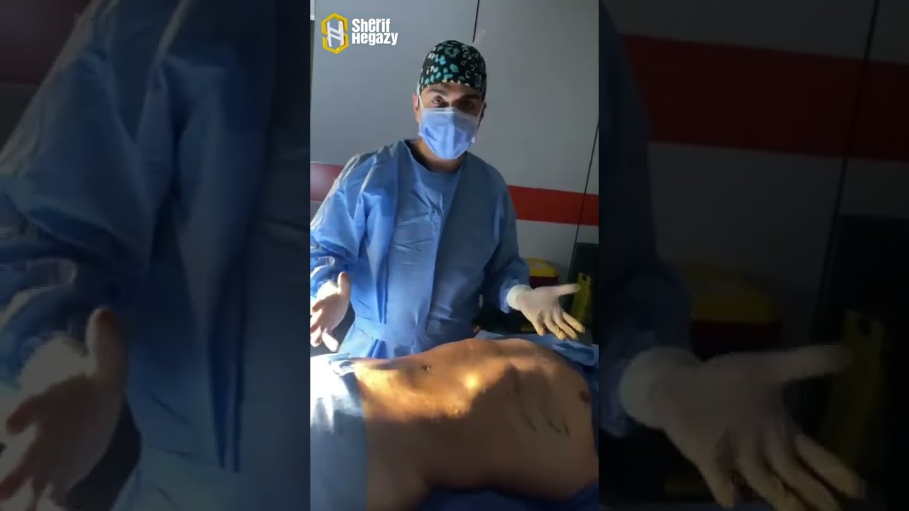شاهد نتيجة التخلص من دهون البطن والاجناب الموضعي بنحت عالي التحديد