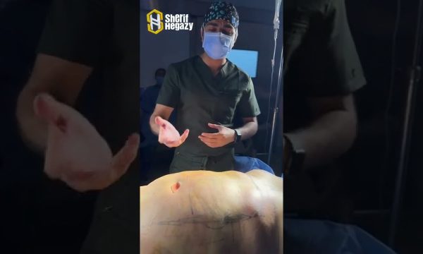 شاهد نتيجة نحت الدهون بالفيزر من داخل غرفة العمليات