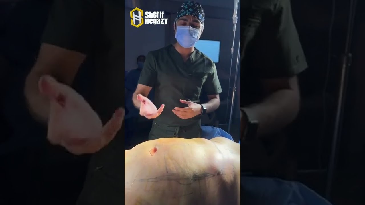 شاهد نتيجة نحت الدهون بالفيزر من داخل غرفة العمليات