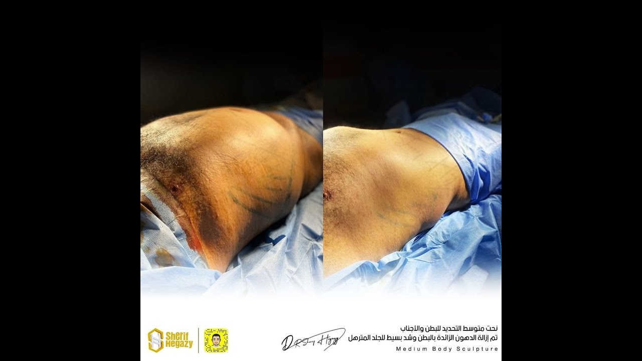 أيه الفرق بين نحت الجسم عالي التحديد ومتوسط التحديد ؟
