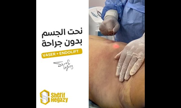شاهد نحت مثالي للجسم بدون جراحة بإستخدام جهازي الفيزر والأندولفت