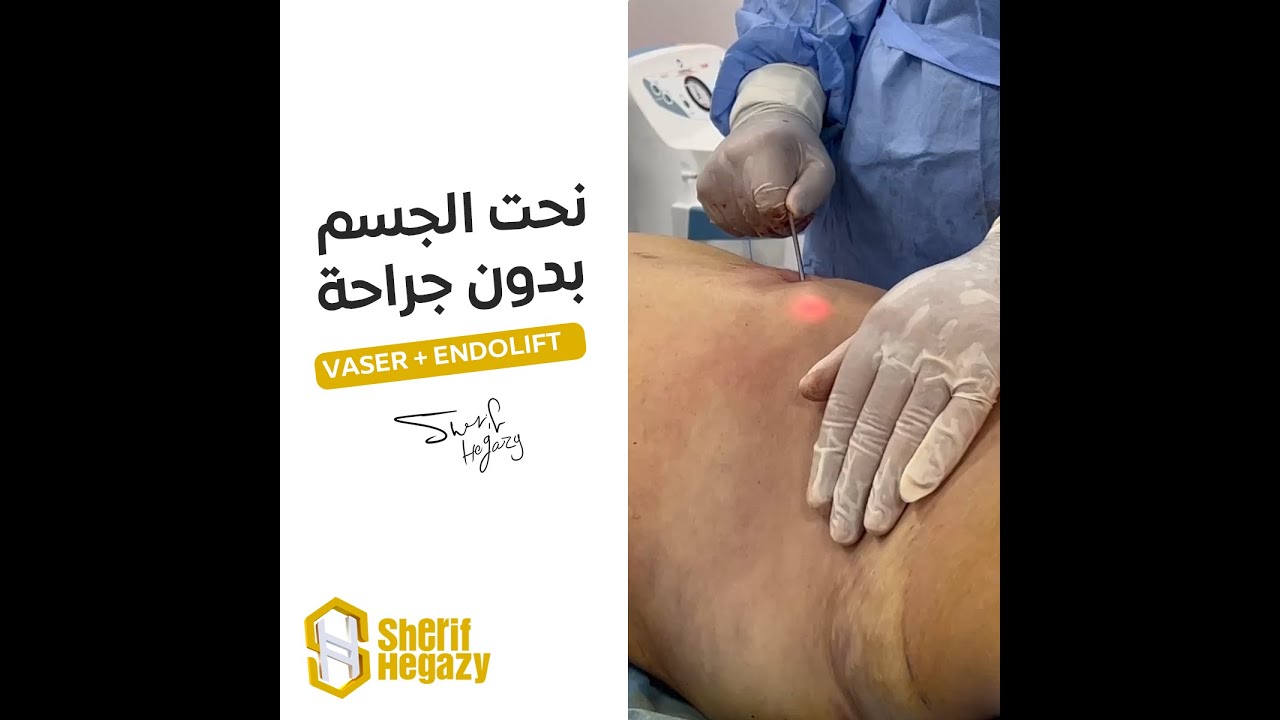شاهد نحت مثالي للجسم بدون جراحة بإستخدام جهازي الفيزر والأندولفت