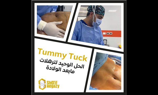 شاهد نتيجة شد البطن للتخلص من ترهلات ما بعد الولادة