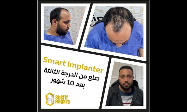 نتيجة مذهلة للتخلص من الصلع من الدرجة الثالثة