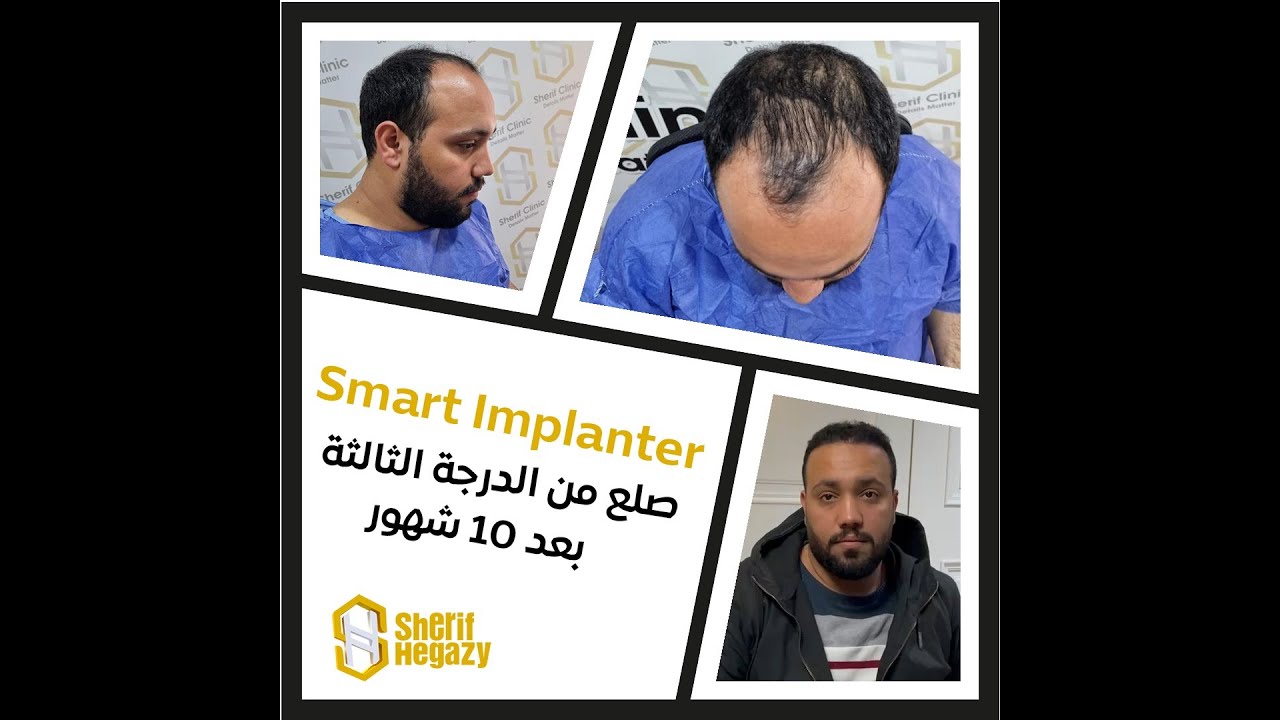 نتيجة مذهلة للتخلص من الصلع من الدرجة الثالثة