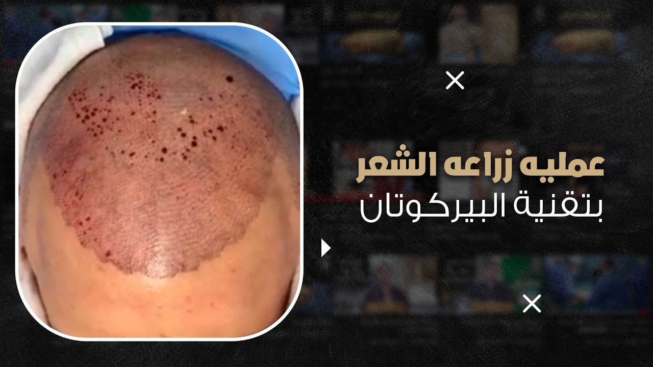 زراعة الشعر في أقل وقت ممكن بأحدث تقنيات زراعة الشعر في العالم