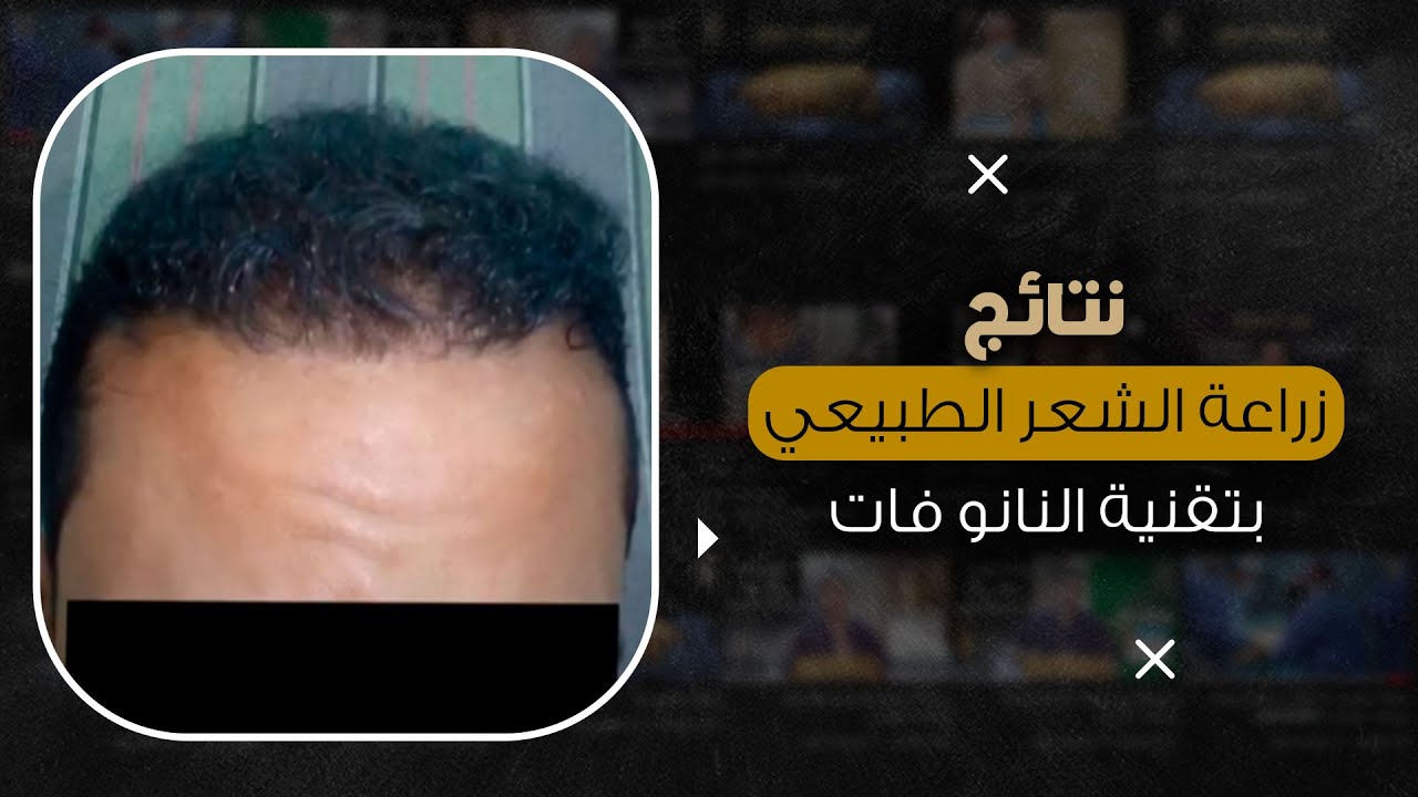 ماذا بعد زراعة الشعر بتقنية النانو فات