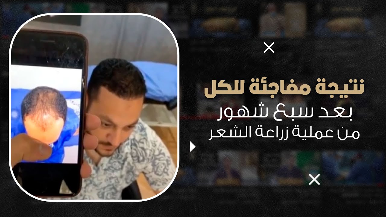 شاهد نتيجة لأحد الحالات بعد زراعة الشعر بسبع شهور