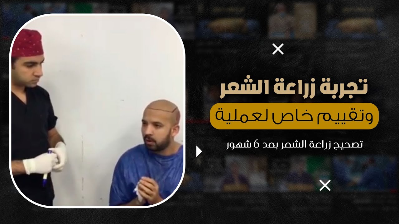 تجربة زراعة الشعر وتقييم خاص لعملية تصحيح زراعة الشعر بعد 6 شهور