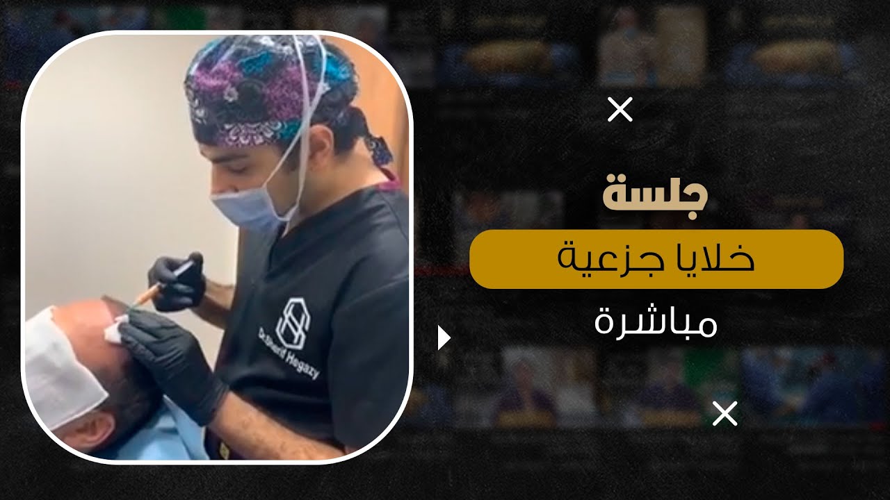 جلسة خلايا جذعية مباشرة