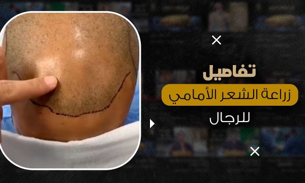 تفاصيل زراعة الشعر الأمامي للرجال