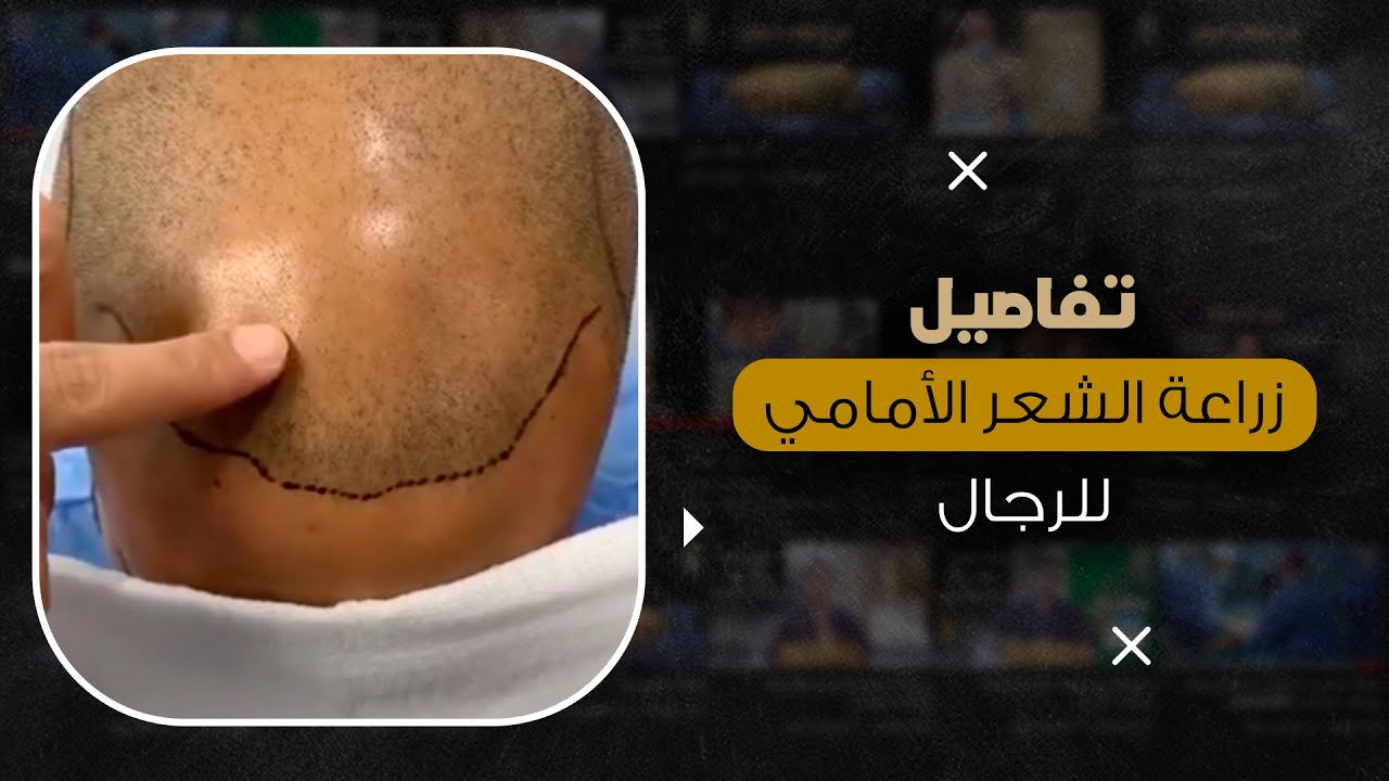 تفاصيل زراعة الشعر الأمامي للرجال