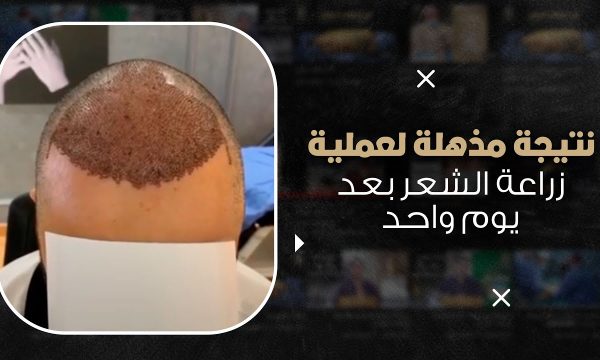 نتيجة مذهلة لعملية زراعة الشعر بعد يوم واحد