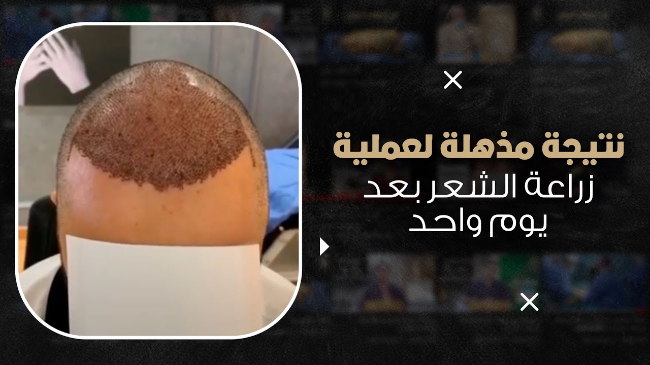 نتيجة مذهلة لعملية زراعة الشعر بعد يوم واحد