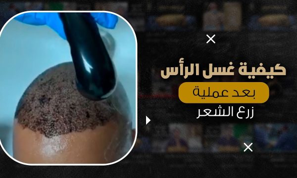 كيفية غسل الرأس بعد عملية زرع الشعر